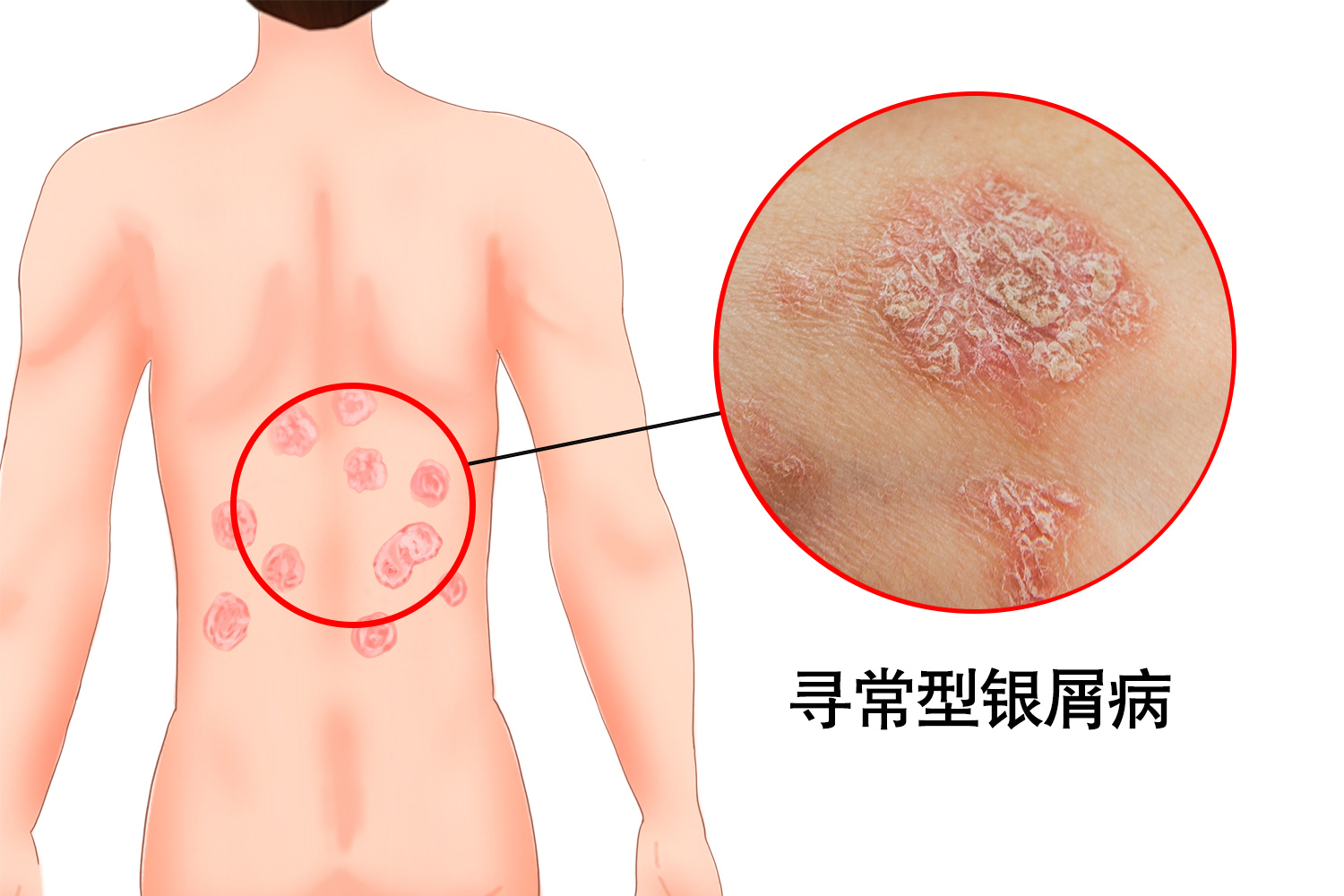 背部寻常型银屑病主要表现为背部皮肤出现红斑,鳞屑,瘙痒等症状