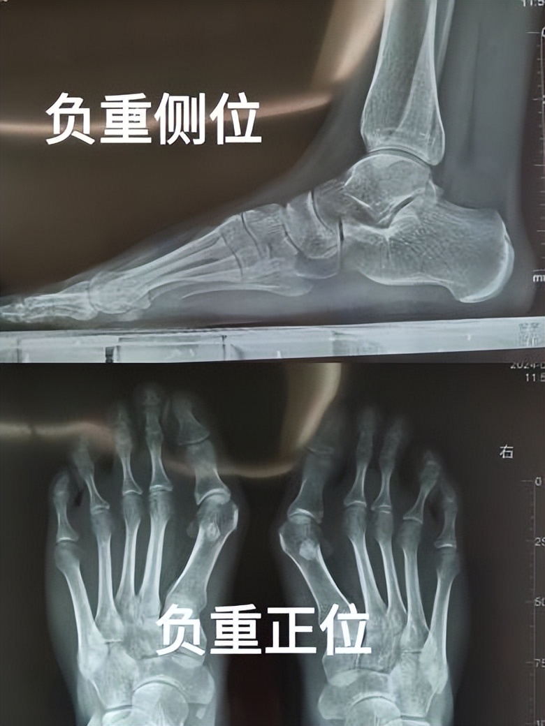 在武汉不到中万做拇外翻微创矫正是种什么体验?超详细经过分享!