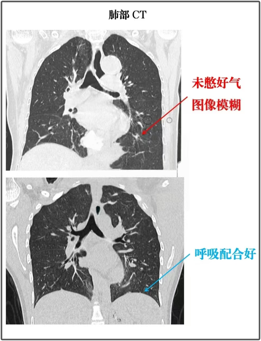 发现肺结节,复查时不要犯这4个错误!