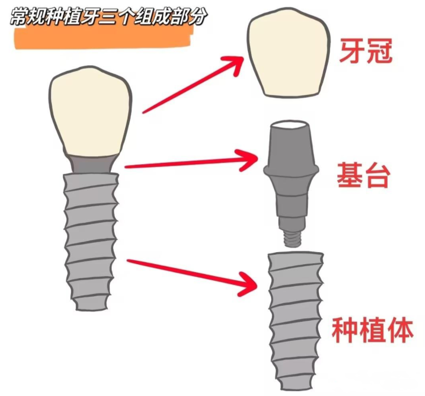 种植牙必用的基台是什么?安装基台会不会痛?怎么选择基台?