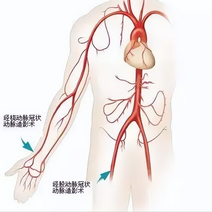 你的血管就是城市里的高速公路,心脏是重要的交通枢纽,而冠脉造影就像