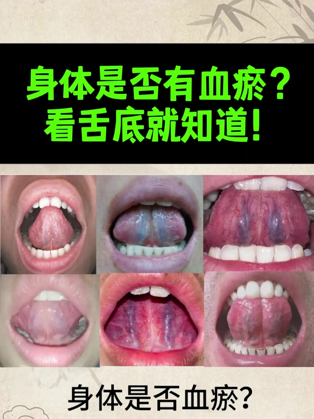 血瘀舌头图片比对图片