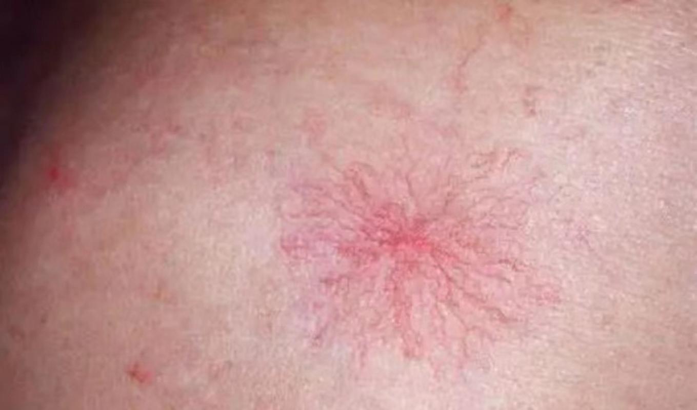 蜘蛛痣是一种特殊的皮肤表现,它的形态像一只小蜘蛛,中间是红点,周围