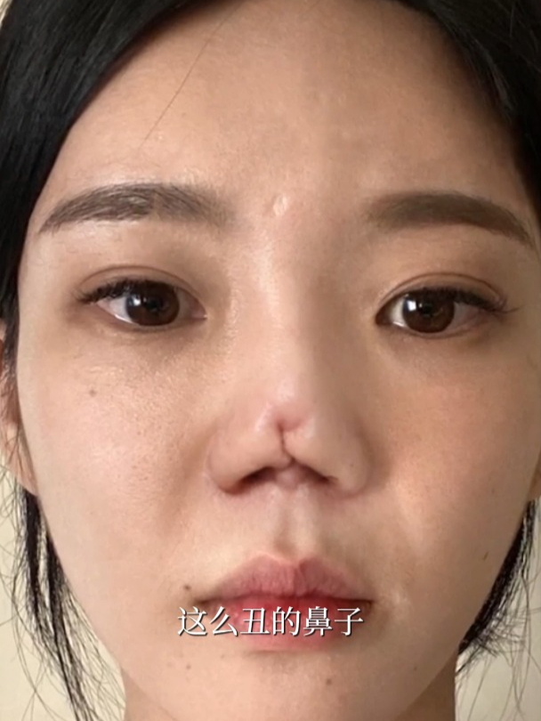 鼻头从无到有,隆鼻失败修复后终于逆袭了!
