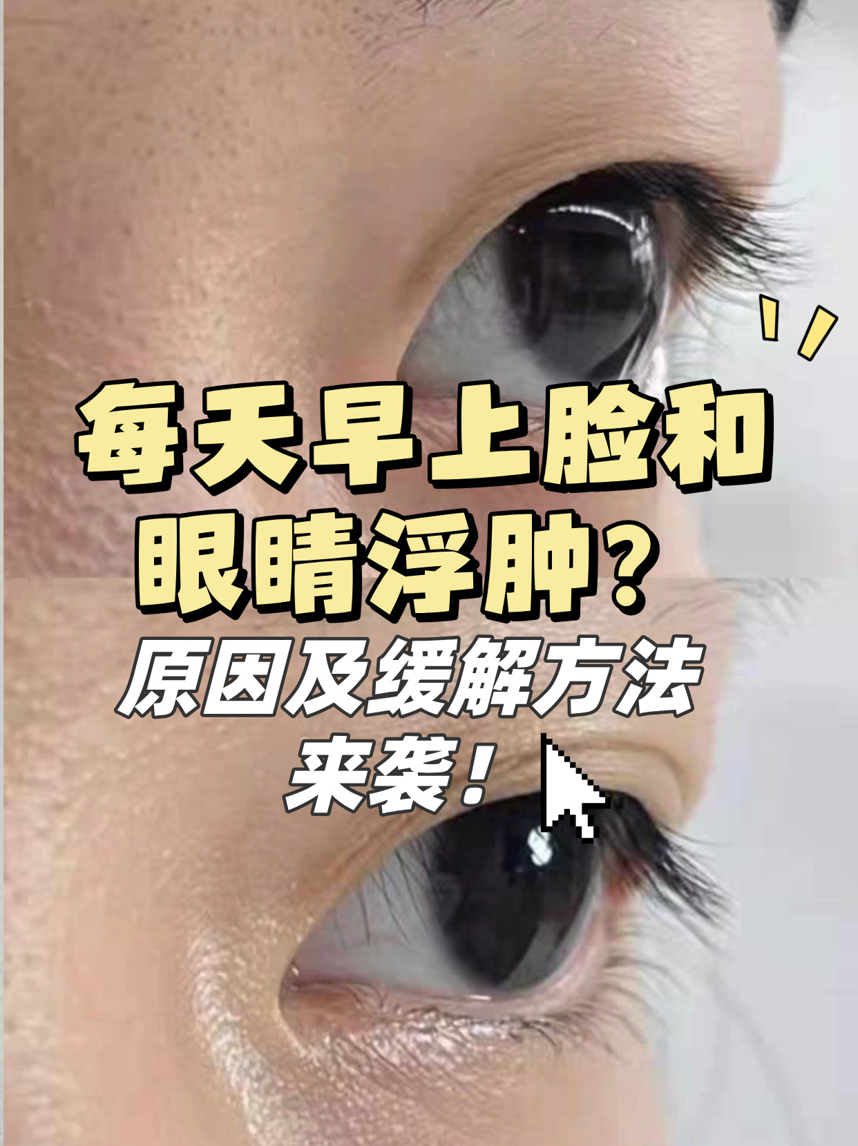 眼睛为什么突然肿了很疼怎么回事为什么在线 眼睛为什么突然肿了很疼怎么回事为什么在线