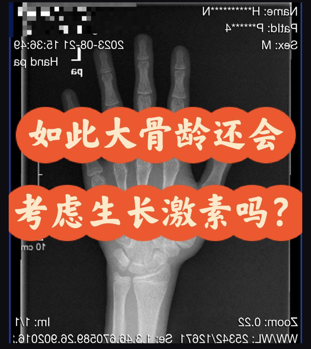 一般而言当女孩骨龄达到14岁男孩骨龄达到16岁左右就