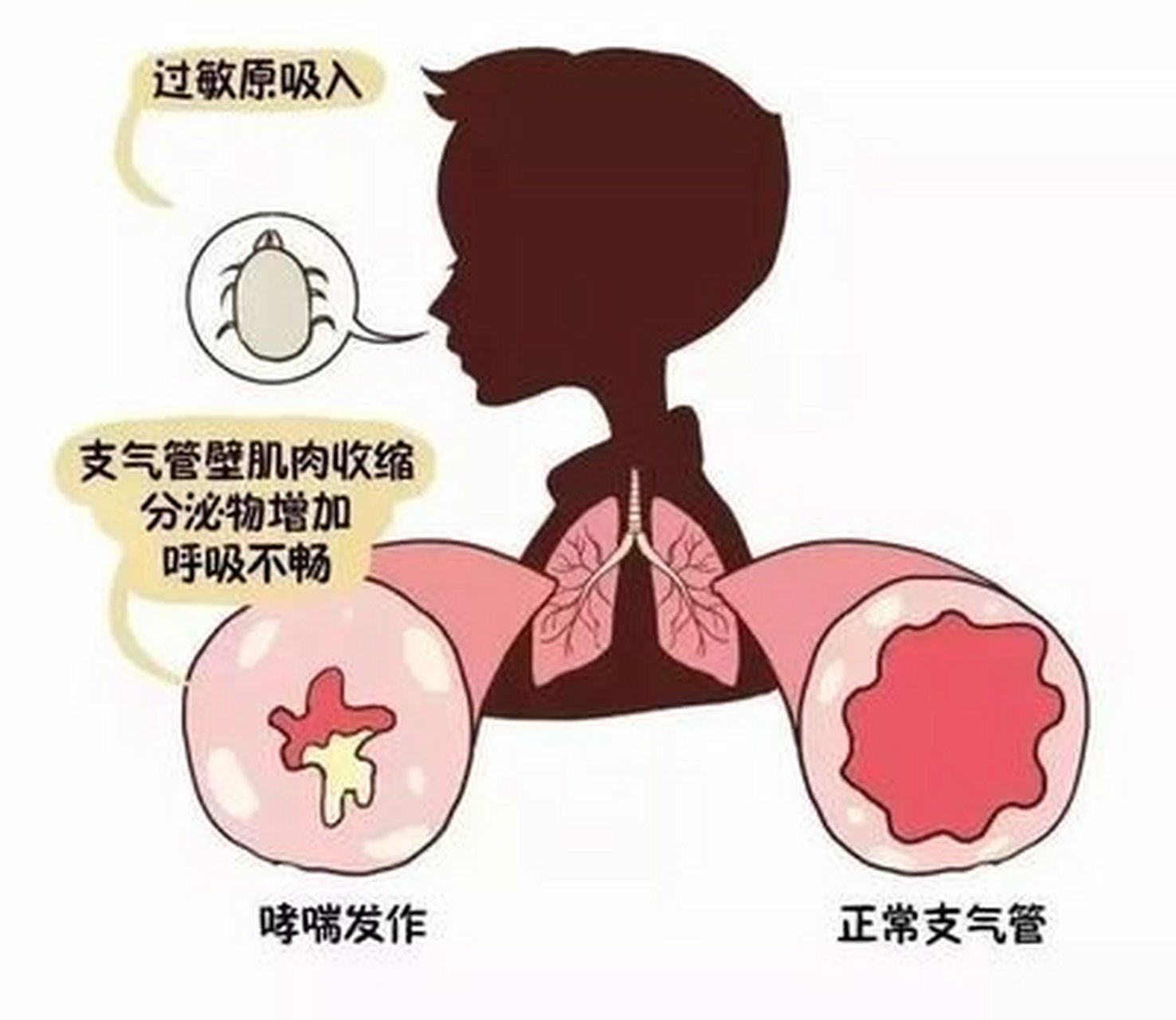 孩子哮喘遇上中医,再难缠也能治!