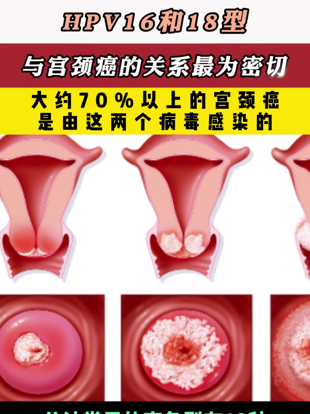 hpv16.18型号与宫颈病变关系密切