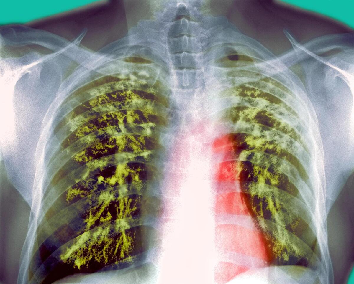 气ct表现肺结石图片前纵隔结节膈肌上的肿瘤前纵隔胸腺结节是什么意思