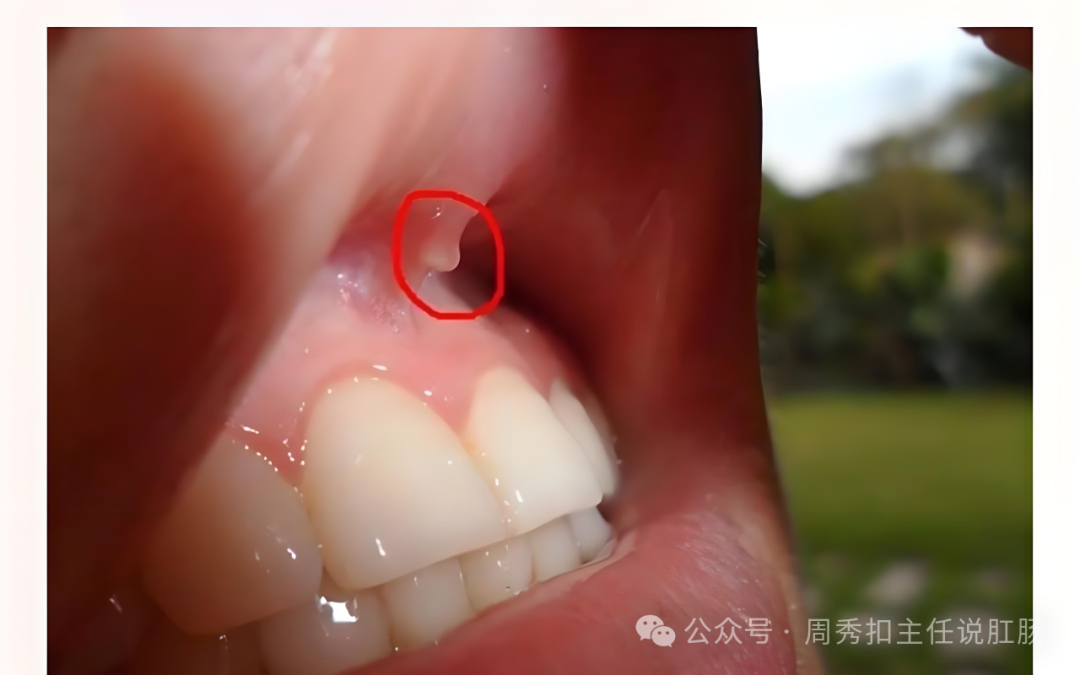 有粉红或灰白米粒大的小点,中医称之为痔疮结节,这个"小点"所在的位置