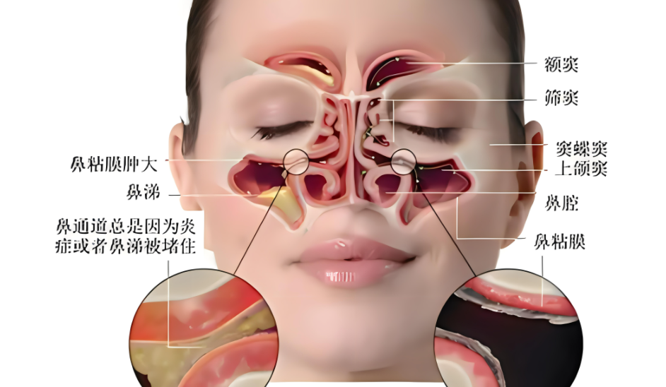 3d鼻窦炎图片症状图片鼻子黎氏区准确位置图鼻窦炎有哪些症状鼻涕分布