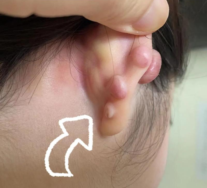 在生理方面和心理方面自测一下,可以帮助你判断是否适合做拉皮手术