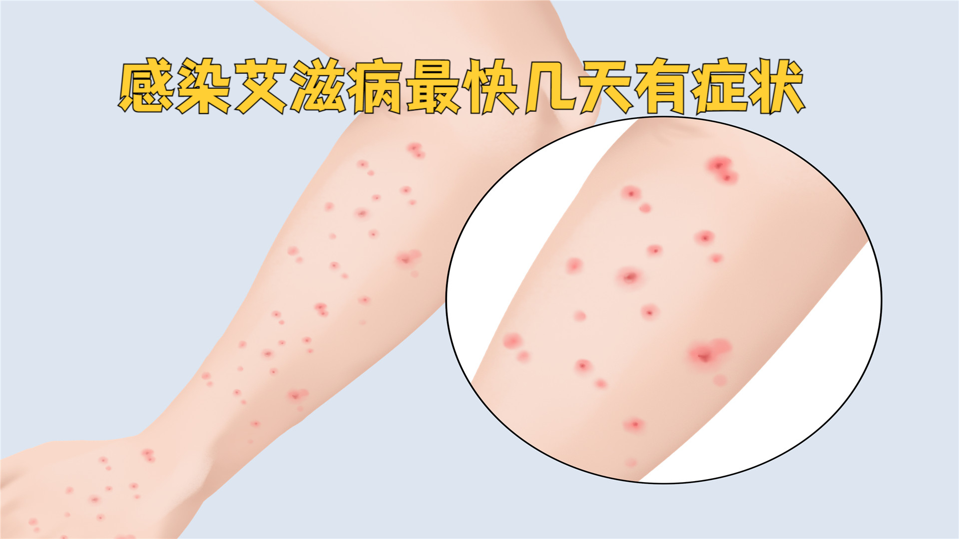 在感染艾滋病病毒后,最快可能2