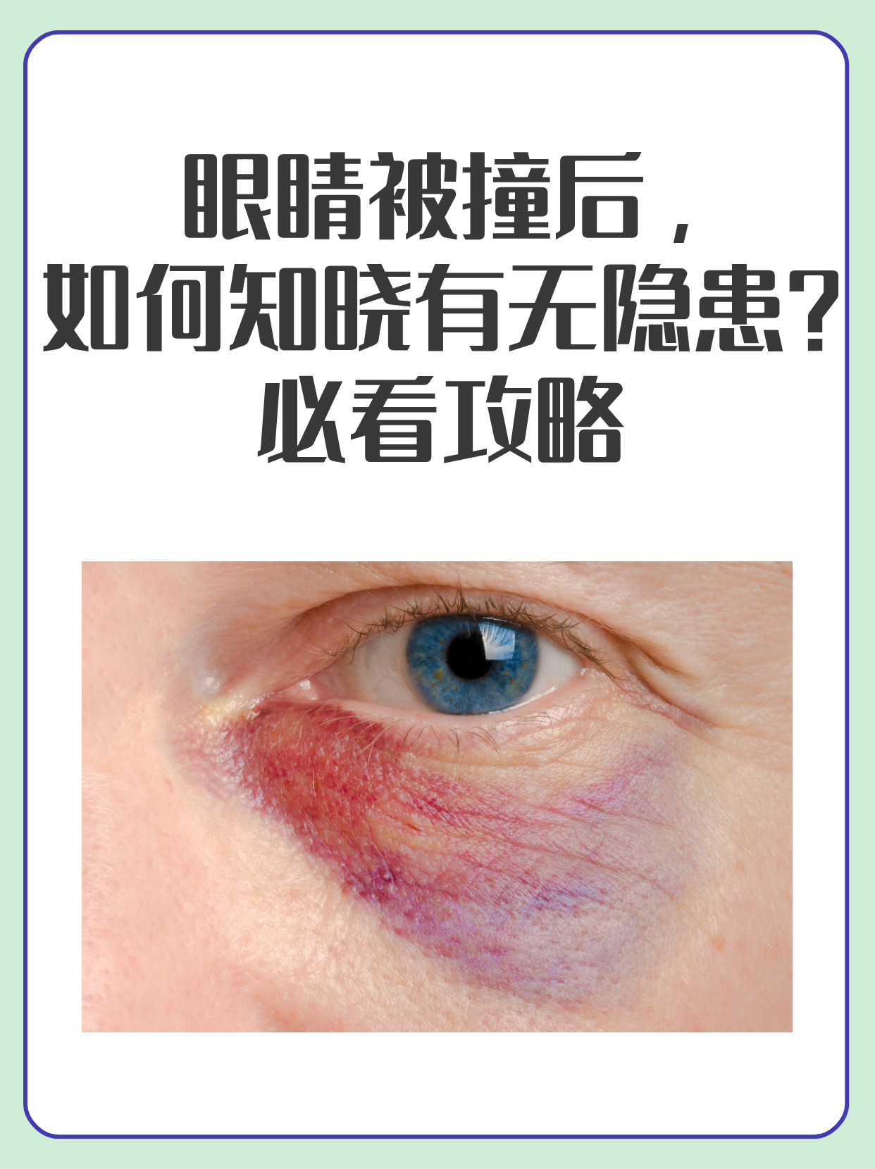 必看攻略 眼睛是十分脆弱的器官,当眼睛不小心被撞,大家可能立马就会