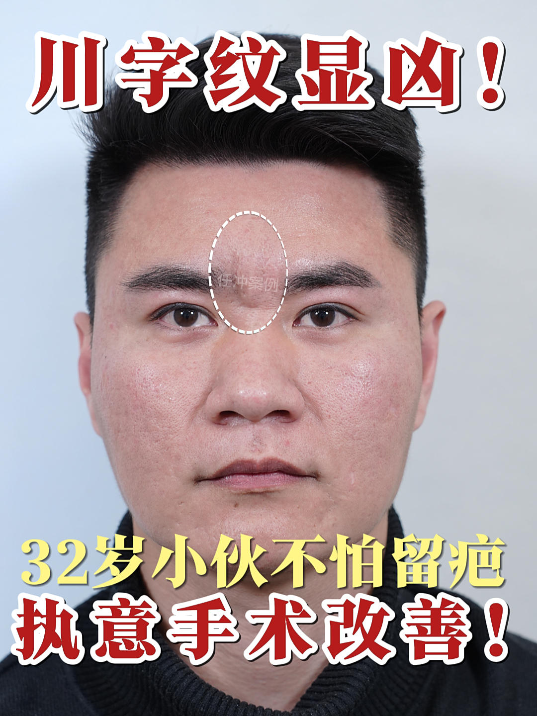 川字纹显凶!32岁小伙不怕留疤,执意手术改善!