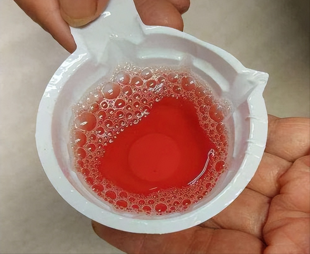 什么是血尿,尿色变红就是血尿吗?一文告诉您尿色变红原因