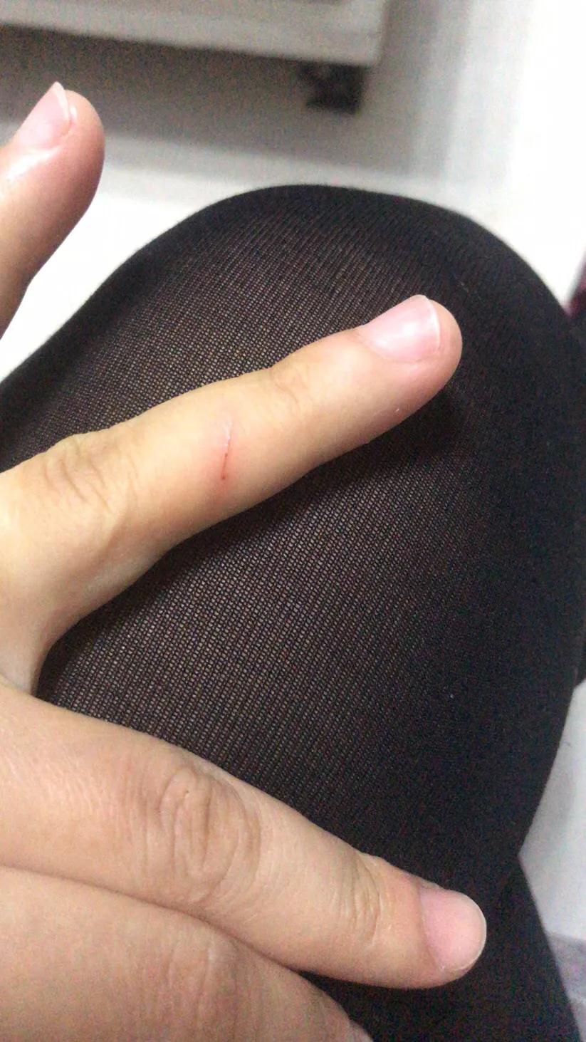 被猫轻微抓伤,打不打针这是个问题?