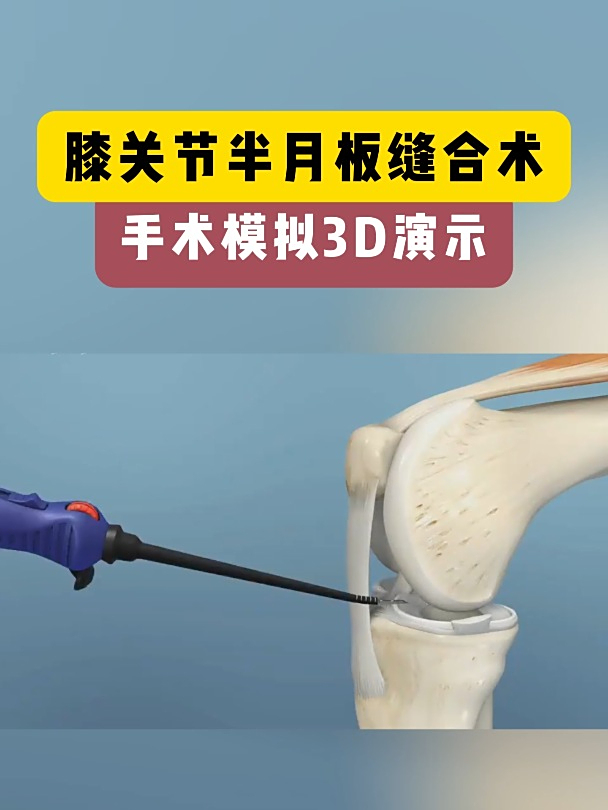 膝关节半月板缝合术,手术模拟3d演示