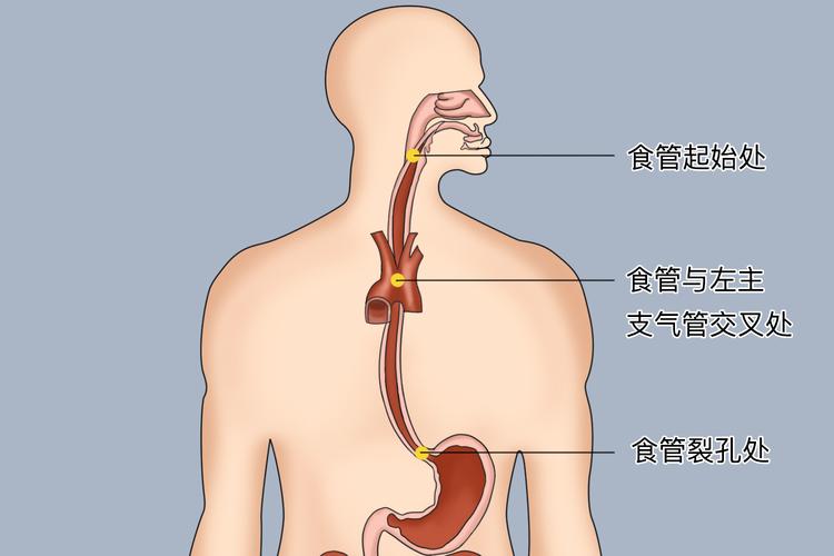 反流性食管炎病根不在胃?医生揭3大隐藏原因,很多人忽略了!