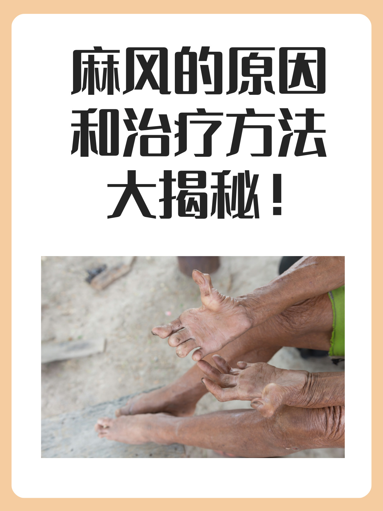 什么病麻风病人的图片麻风病现在叫什么病麻风病的症状表现图片大麻风