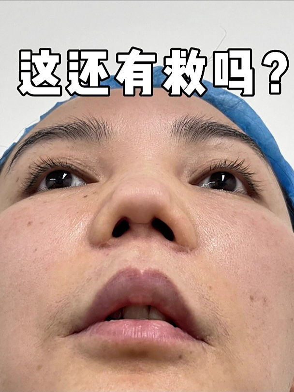 挛缩鼻应该怎么修复?