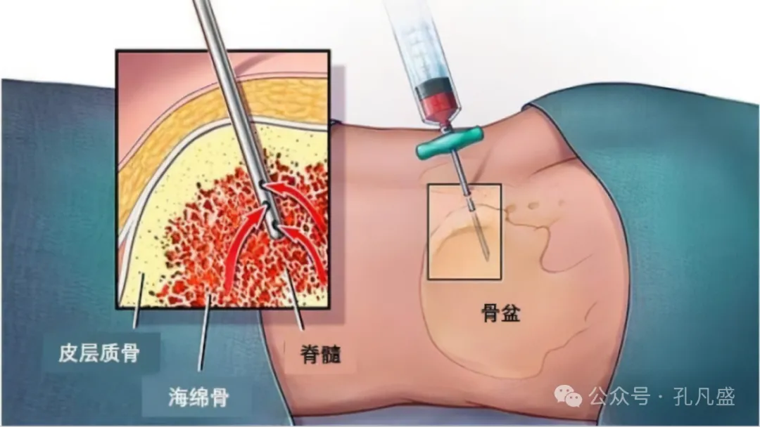 骨髓穿刺和骨髓活检有什么不同?分别适用于什么情况?
