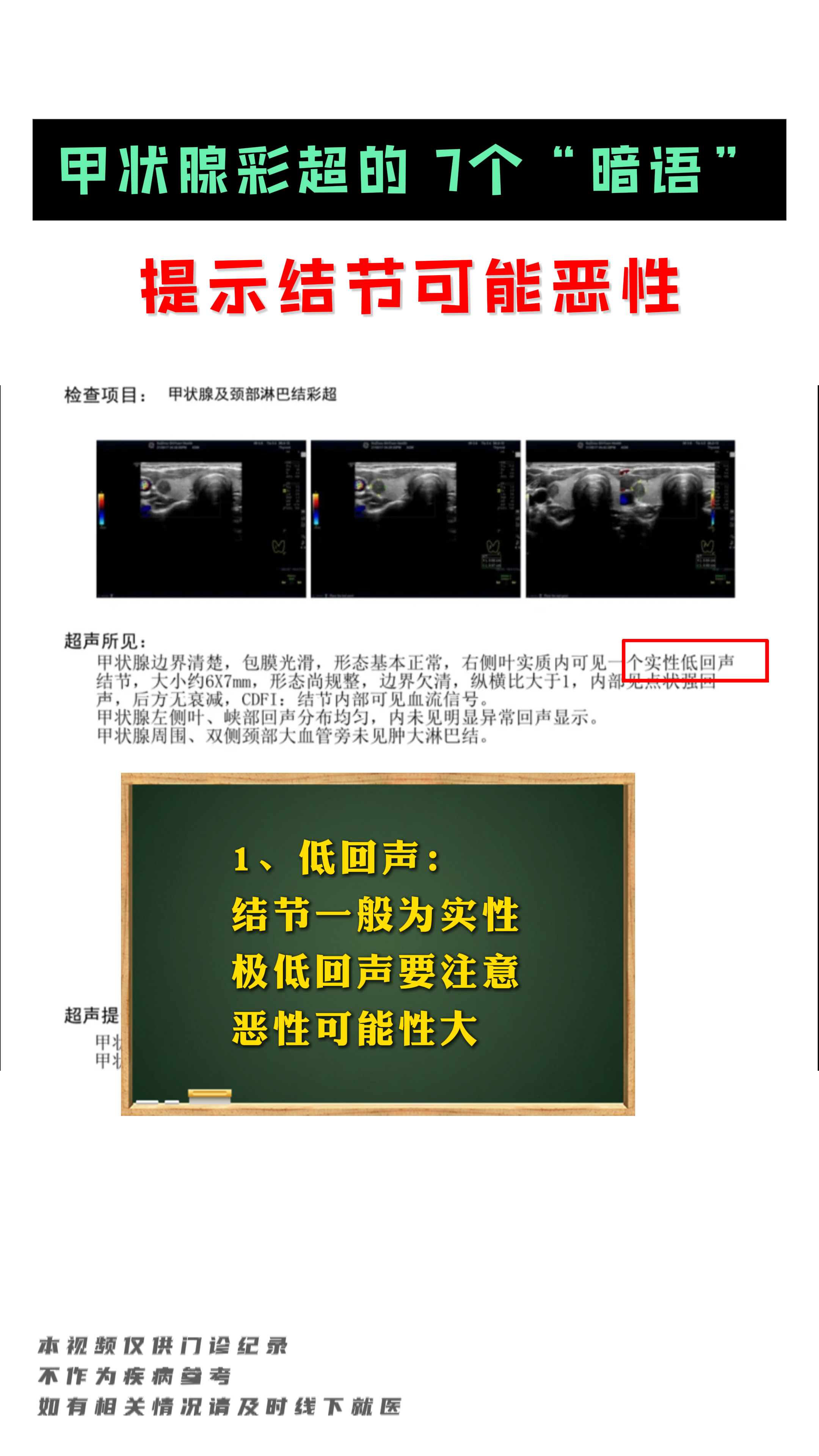 纵横比>1:恶性几率高甲状腺彩超低回声结节甲状腺结节超声甲状腺结节