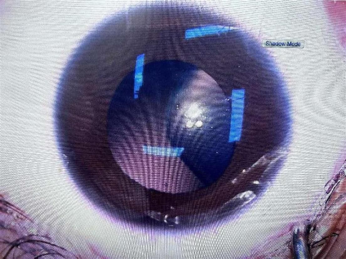 马凡综合征导致晶状体脱位能恢复吗?武汉普瑞眼科助少年还原视力