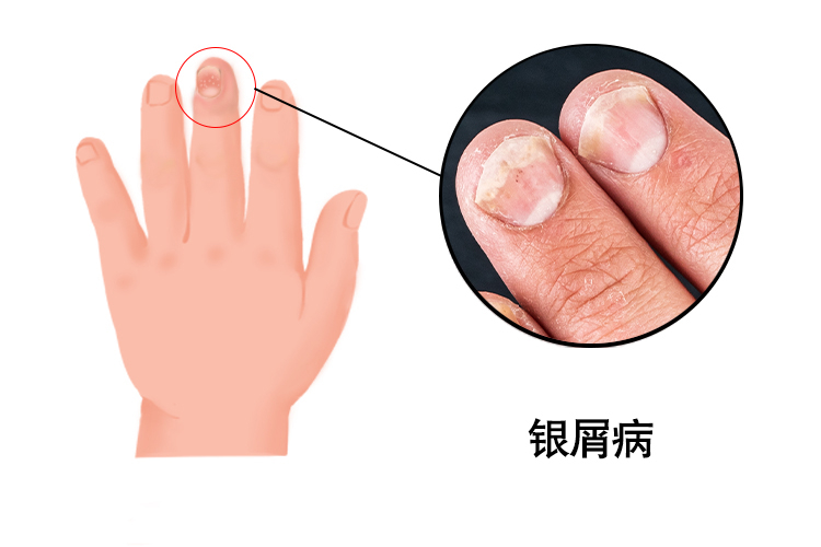 手指甲有轻度银屑病,治疗多久才能见效?