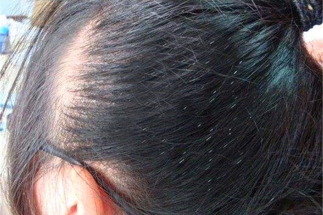 头上为什么会长虱子什么原因引起为什么在线