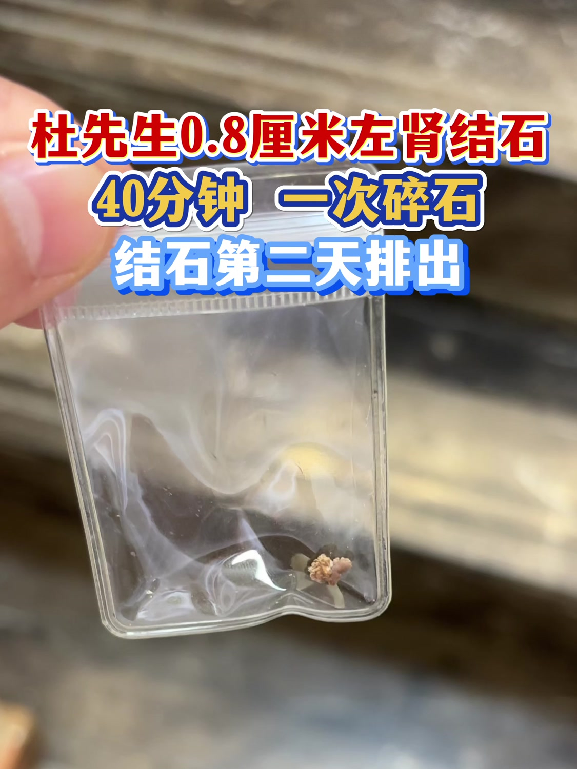 杜先生0.8厘米左肾结石,碎石一次结石第二天排出