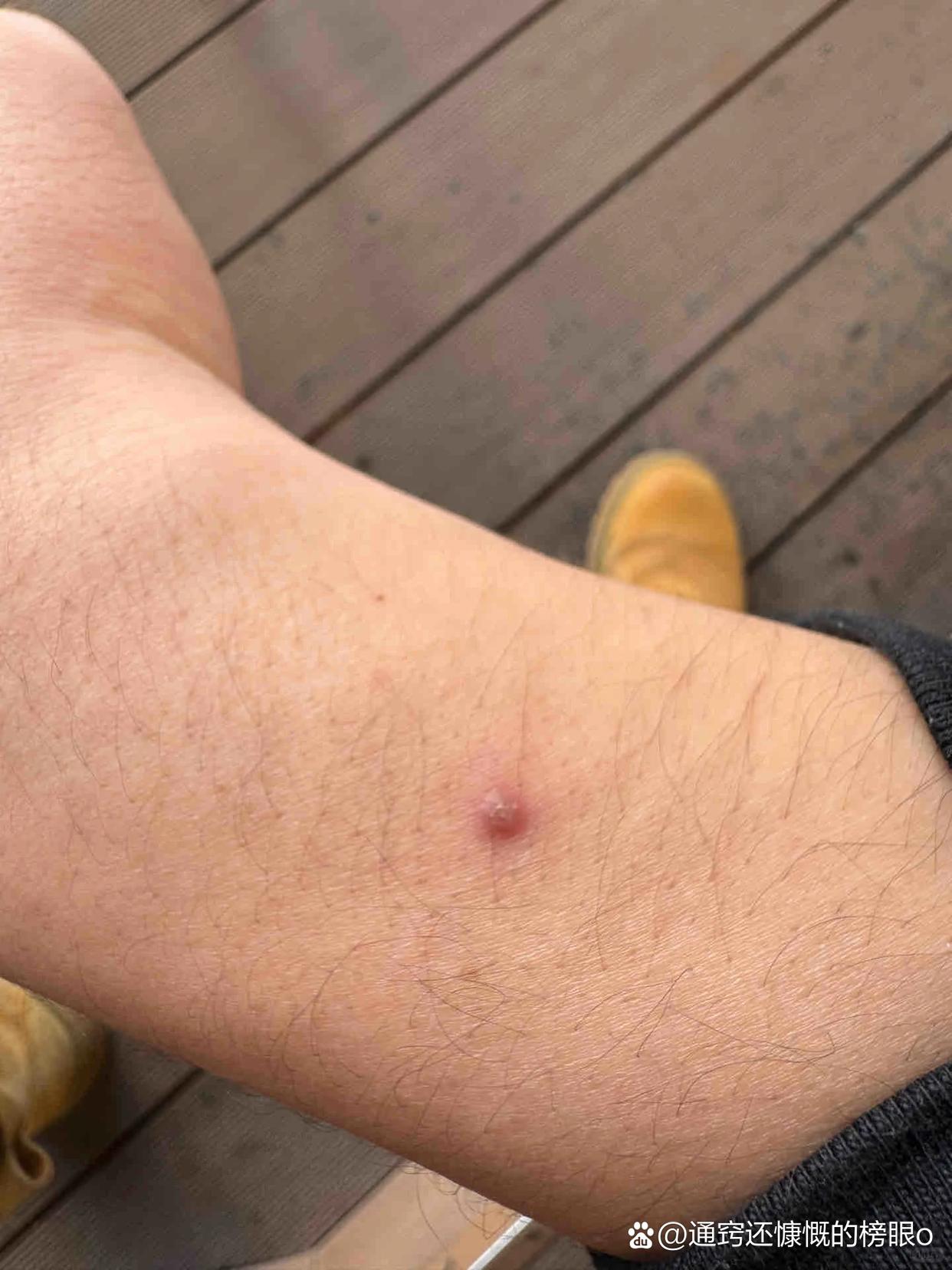 第二尖锐湿疣的症状和图片男性的hpv初期图片男性hpv图片尖锐湿疣