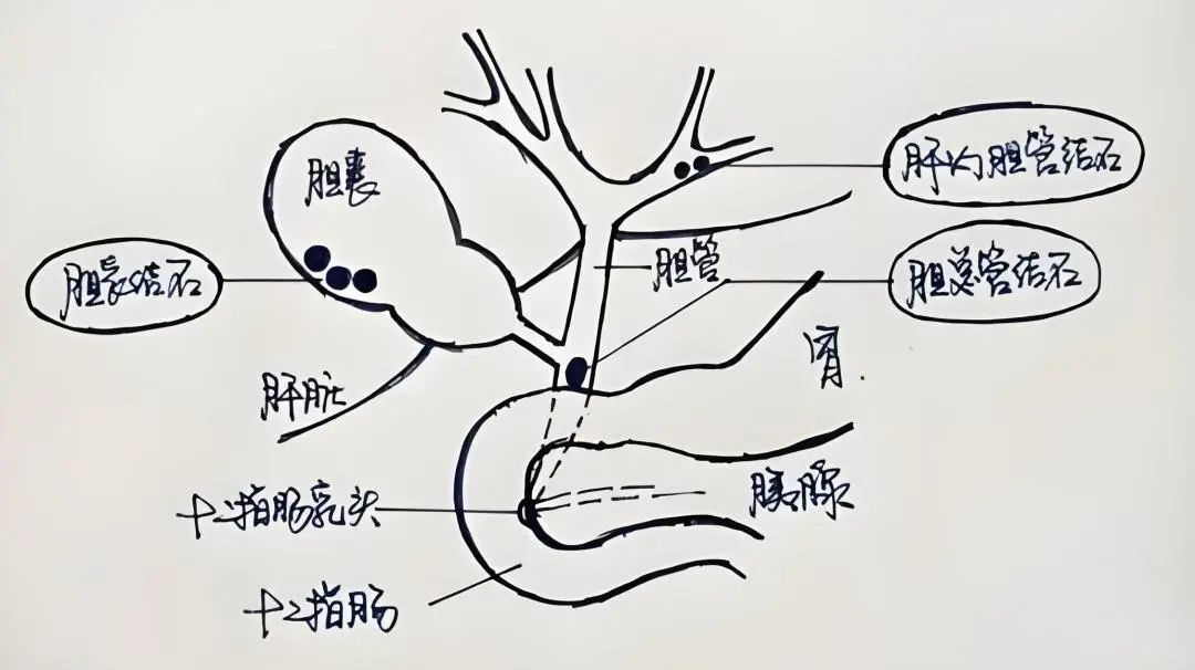胆结石,一个排石妙方,排石不割胆!教你免去一刀之苦!