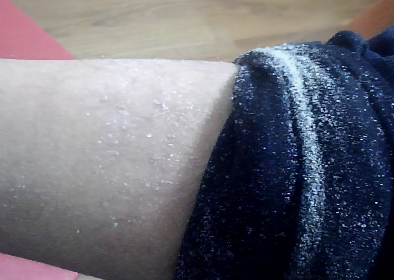 腿上总掉皮屑?可能是缺乏维生素,这些食物帮你养回水润肌肤!