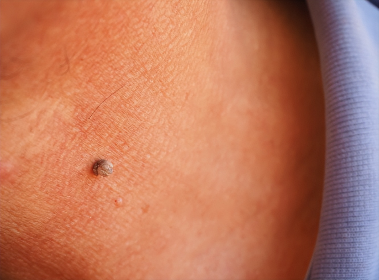 为什么会长小肉粒