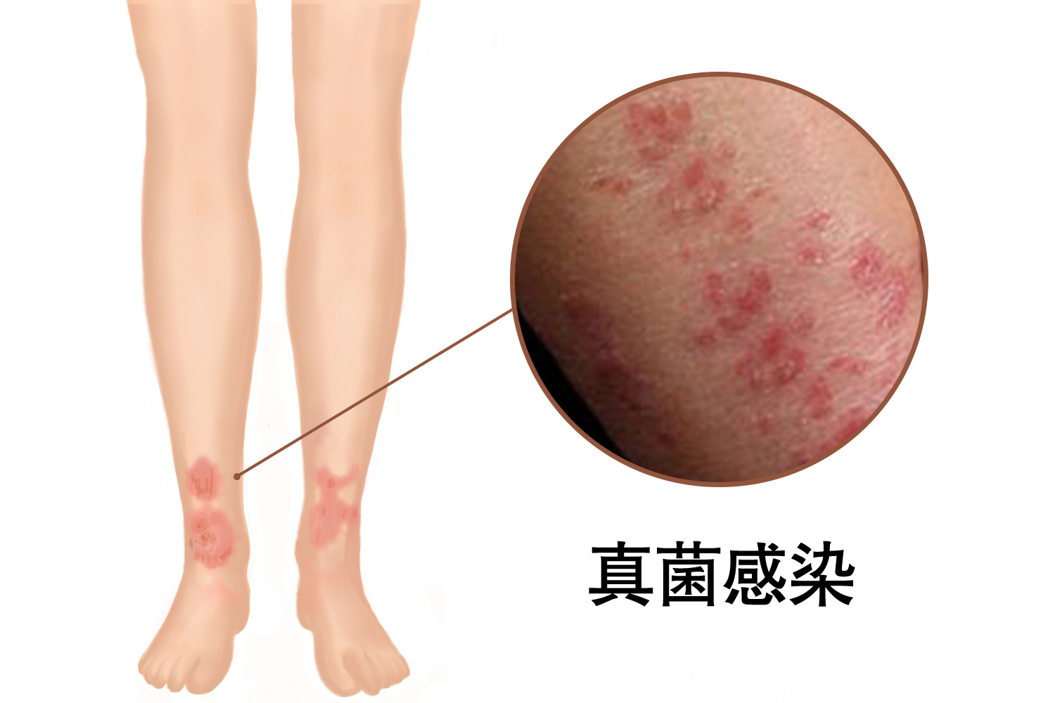 腿部真菌感染真的会危及到截肢吗? 腿部真菌感染是什么?
