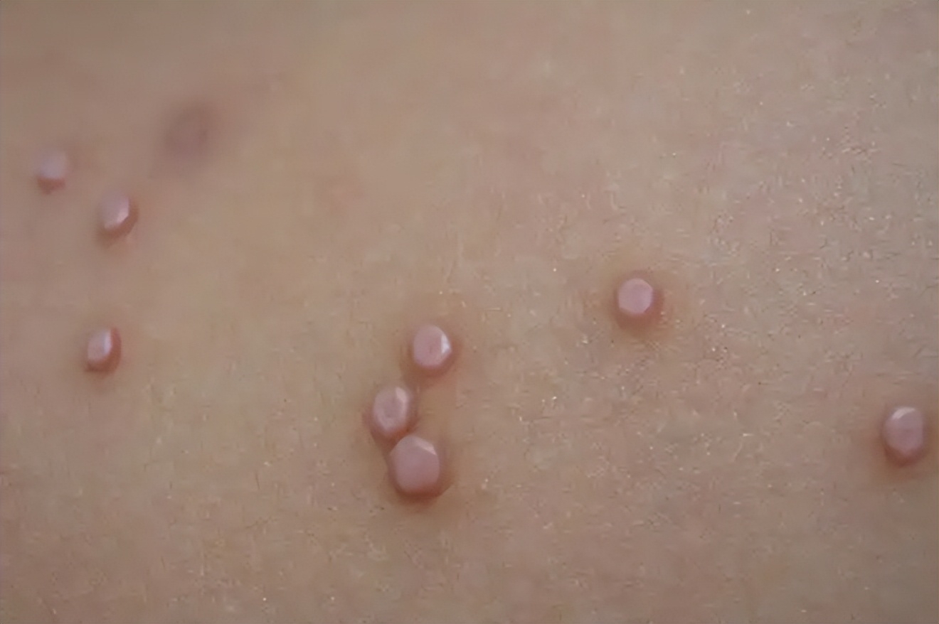 不论男女,身上长出这5种"瘊子",或已感染hpv病毒!千万别轻视