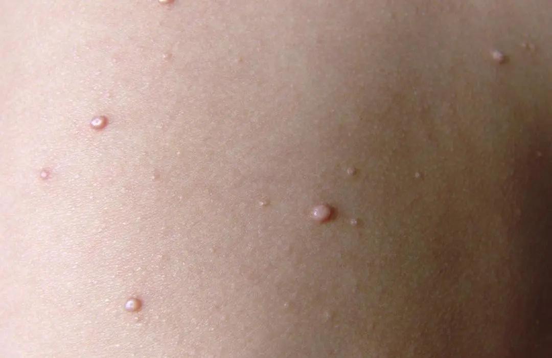 不论男女,身上长出这5种"瘊子",或已感染hpv病毒!千万别轻视