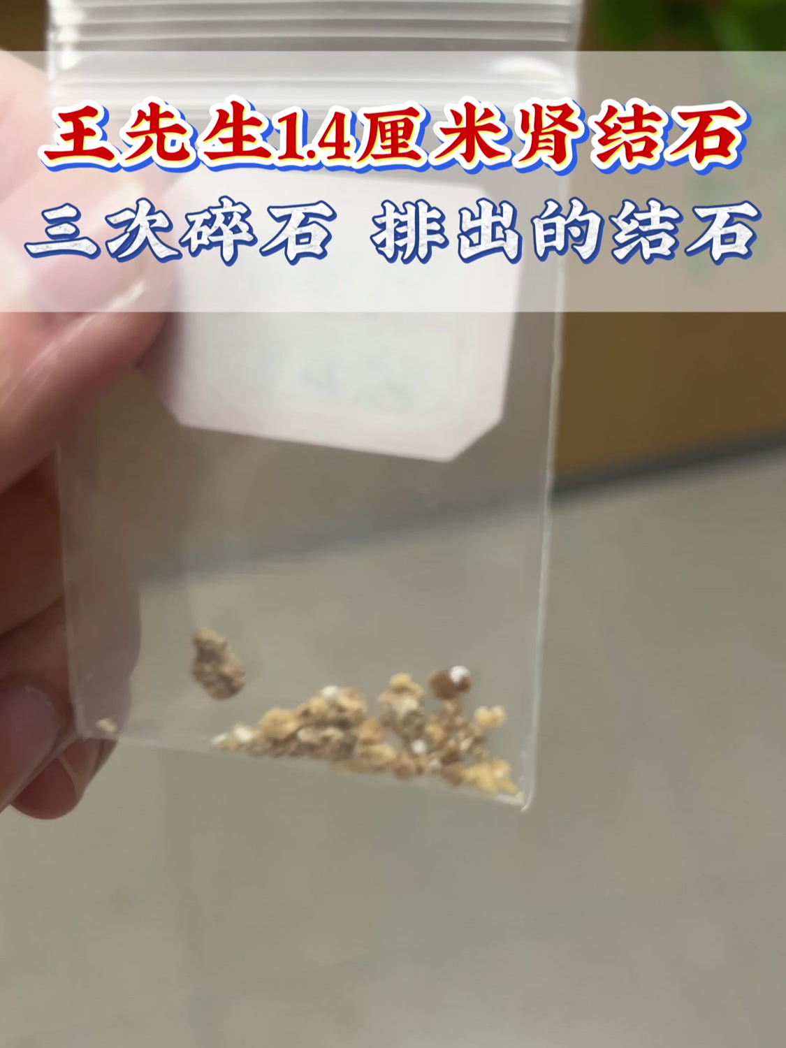 王先生1.4厘米肾结石,碎石三次,排出的结石
