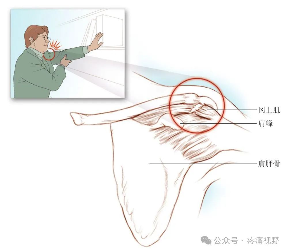 肩袖撕裂的临床特征和治疗！