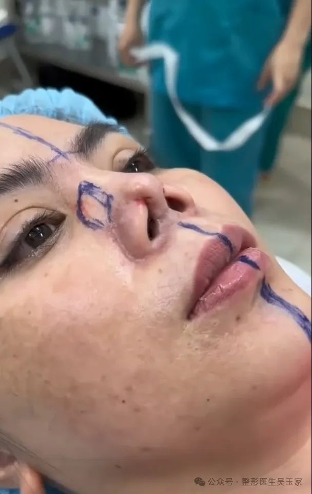 42 岁的我,曾因隆鼻手术失败陷入苦恼