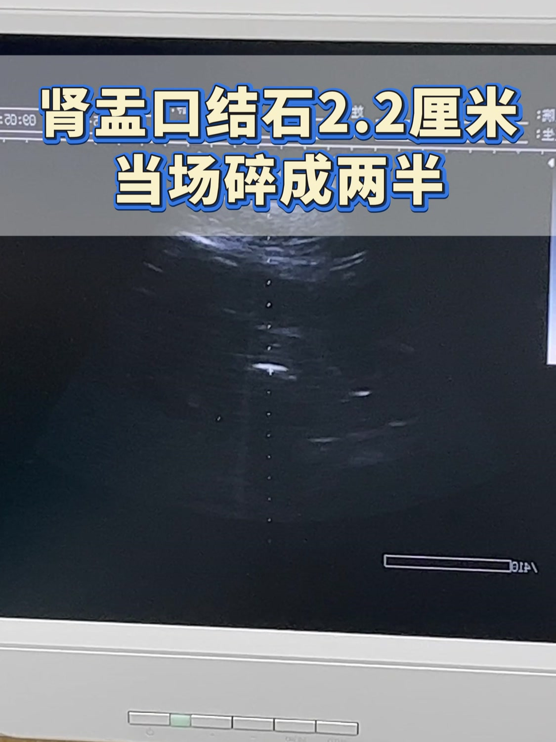 肾盂口结石2.2厘米,当场被碎成两半