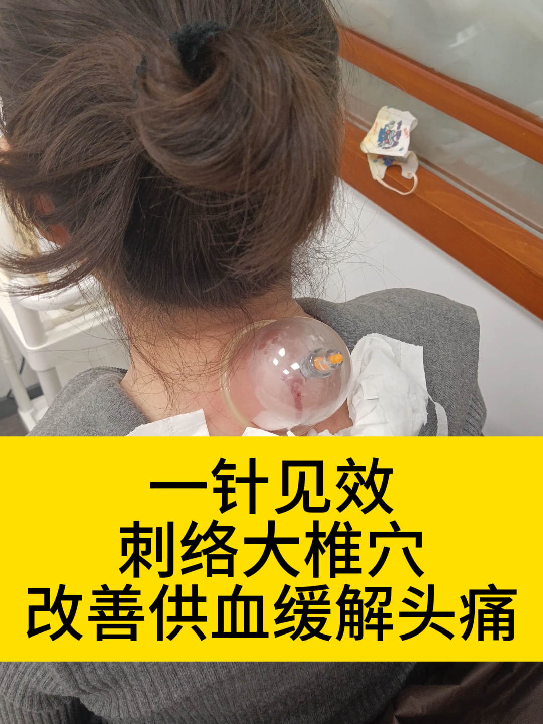 中医一针见效,刺络拔罐大椎穴,有效改善供血,缓解头痛!