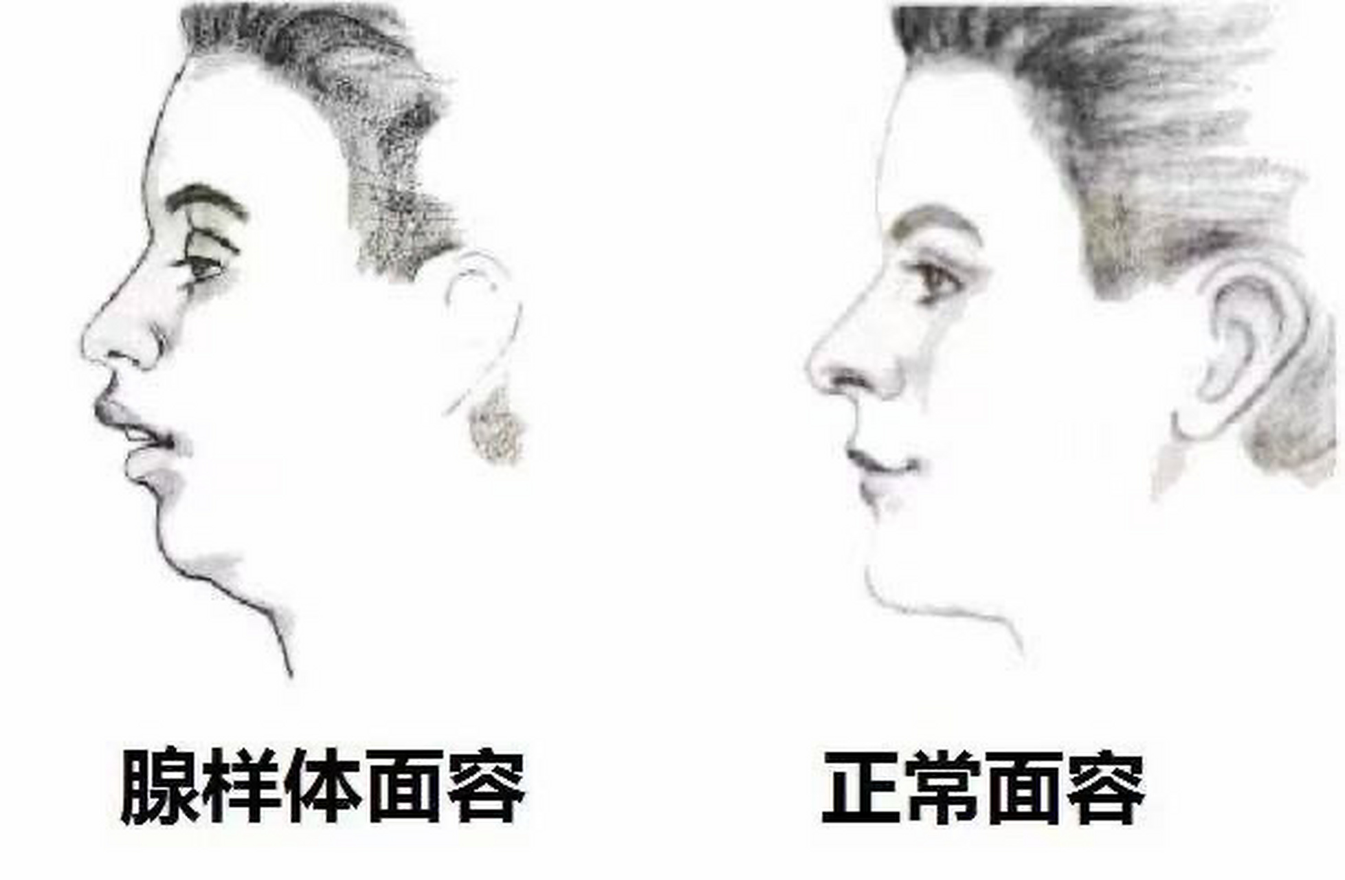 孩子为何会出现腺样体面容?