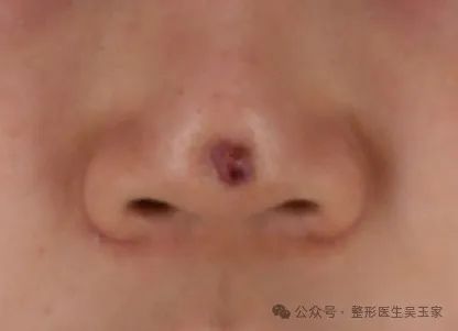 她当初怀着变美的期待去做隆鼻手术,却没想到术后出现了重度感染,鼻尖
