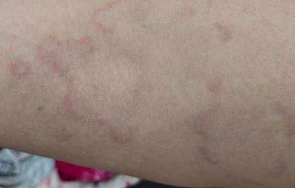 身上为什么总是痒一块,红一块的?莫名出现皮疹的原因,弄清楚了