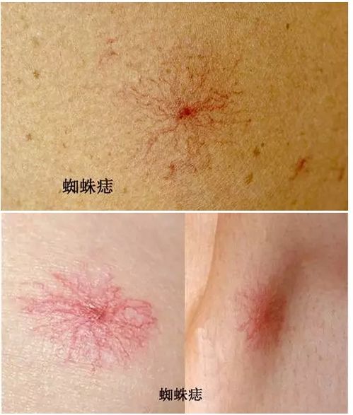 身上出现了蜘蛛痣,就意味着有肝硬化了吗?