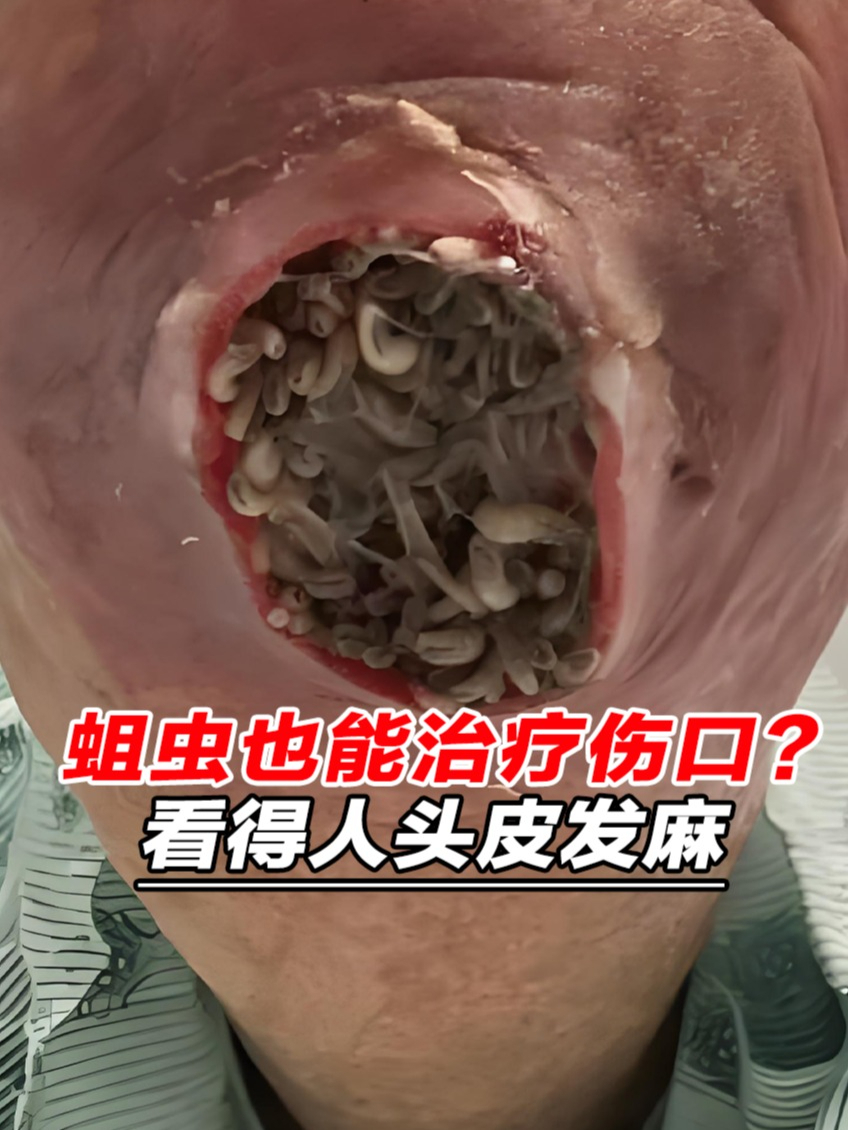 蛆虫也能治疗伤口?看得人头皮发麻,军医真就主打一个能活着就行