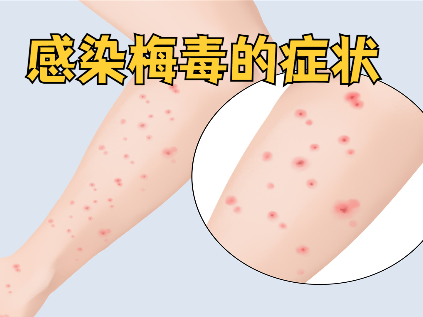 硬下疳: 这是梅毒一期的典型症状,通常在感染梅毒螺旋体后的 2