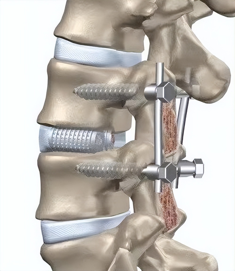 做完腰椎"打钉子"的手术,钉子会松吗?自己可以感觉到吗?